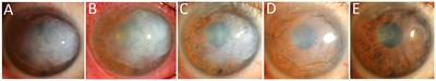 Subepithelial white deposition in the cornea associated with silicone oil and surgical management: a case report